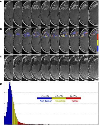 Case report: Fractional brain tumor burden magnetic resonance mapping to assess response to pulsed low-dose-rate radiotherapy in newly-diagnosed glioblastoma